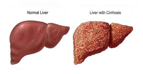 liver cirrhosis