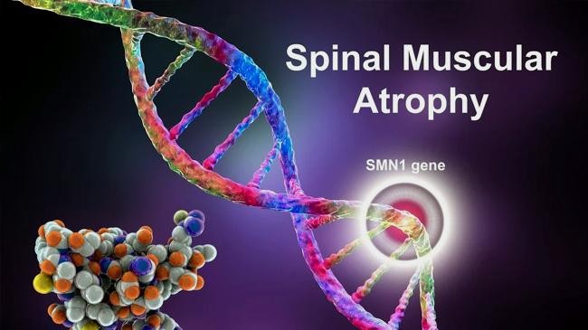 rare disease spinal muscular atrophy