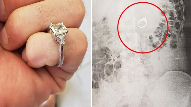 girl swallowed ring